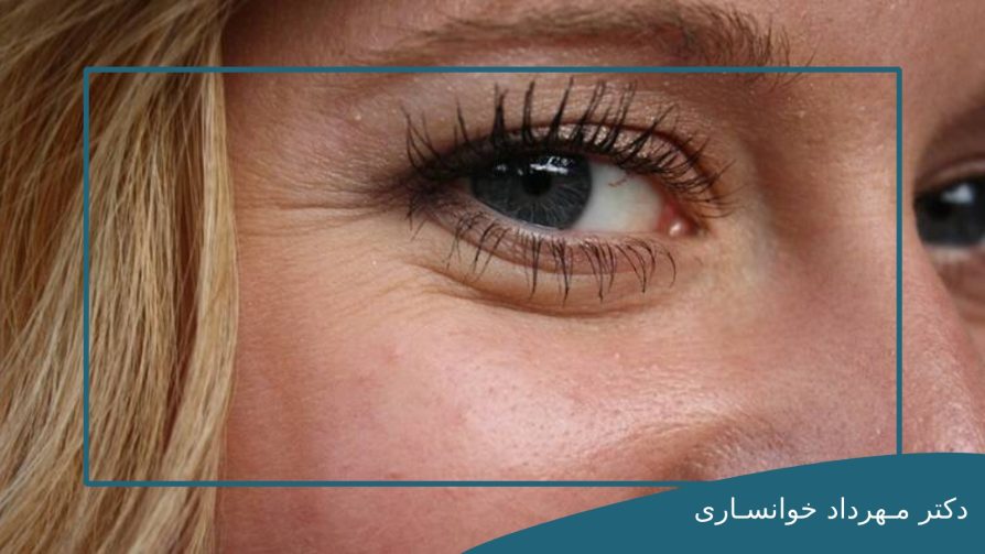 چروک دور چشم ها--dr-mkhansari