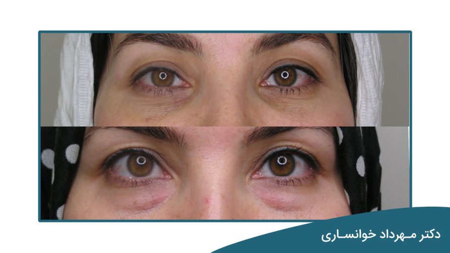 چه افرادی کاندید جراحی پلک می باشند؟ - dr-mkhansari