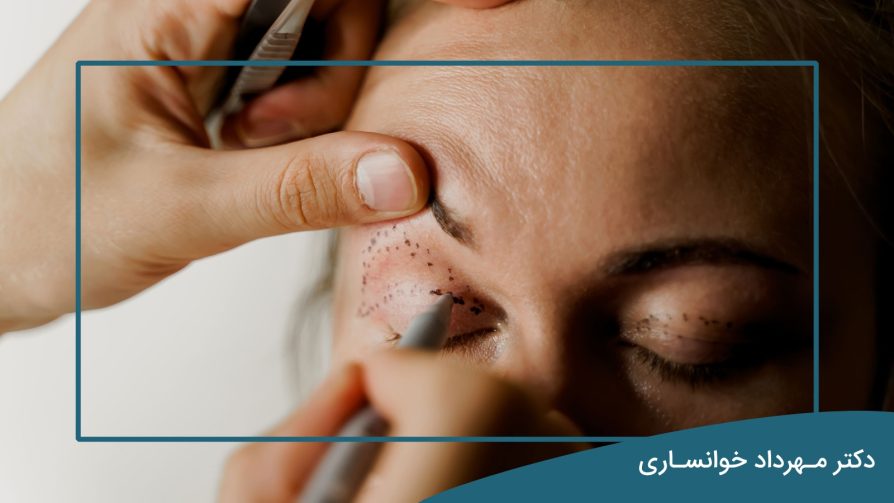 روش جایگزین بلفاروپلاستی-دکتر خوانساری