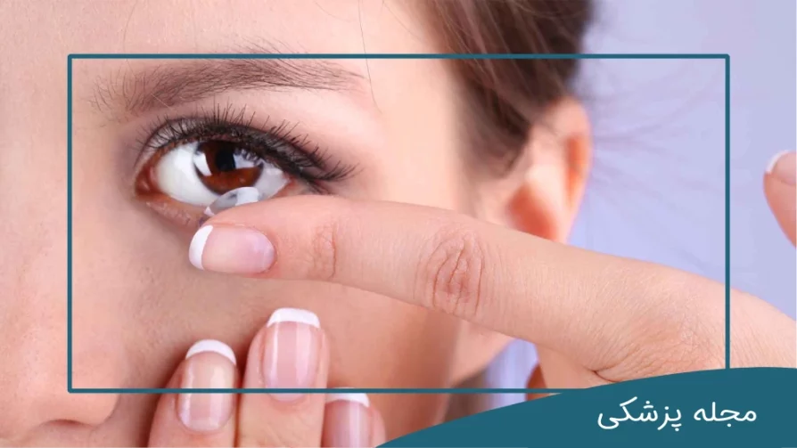 لنز تماسی - dr-mkhansari