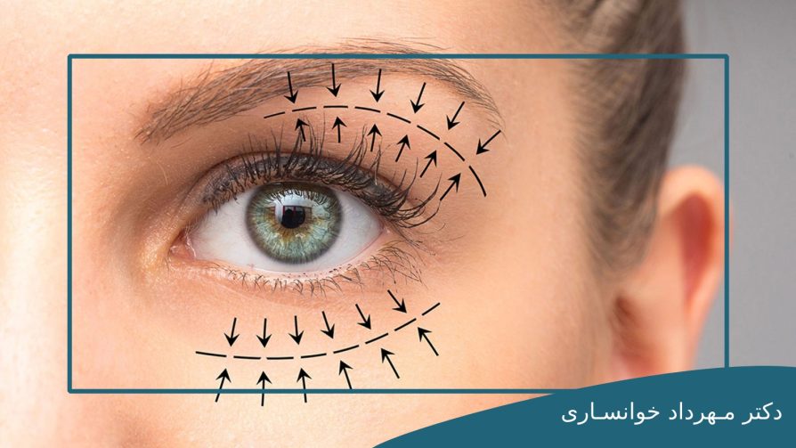 هزینه جراحی پلک-dr-mkhansari