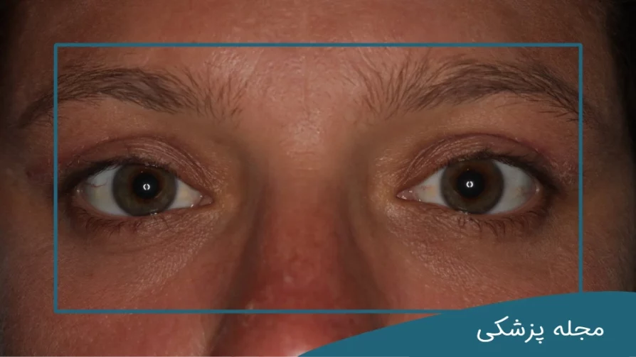 ترمیم عمل بلفاروپلاستی با دکتر خوانساری