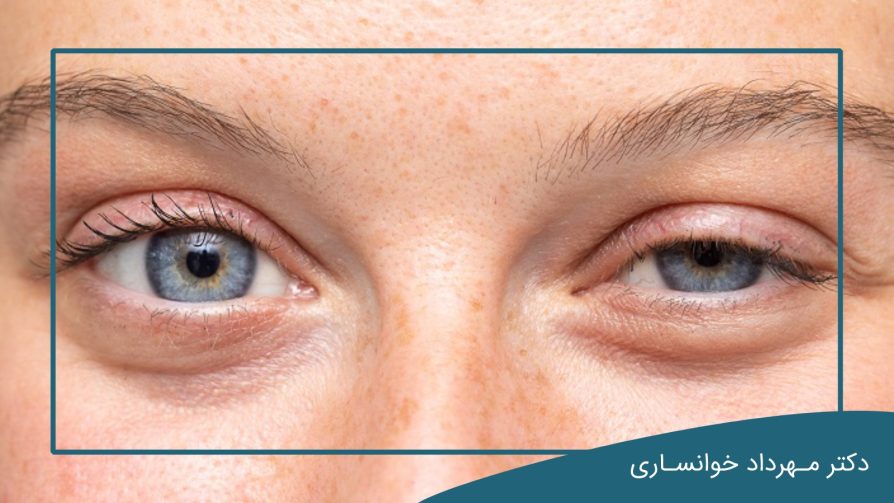 چای کیسه ای برای پف چشم-dr-mkhansari