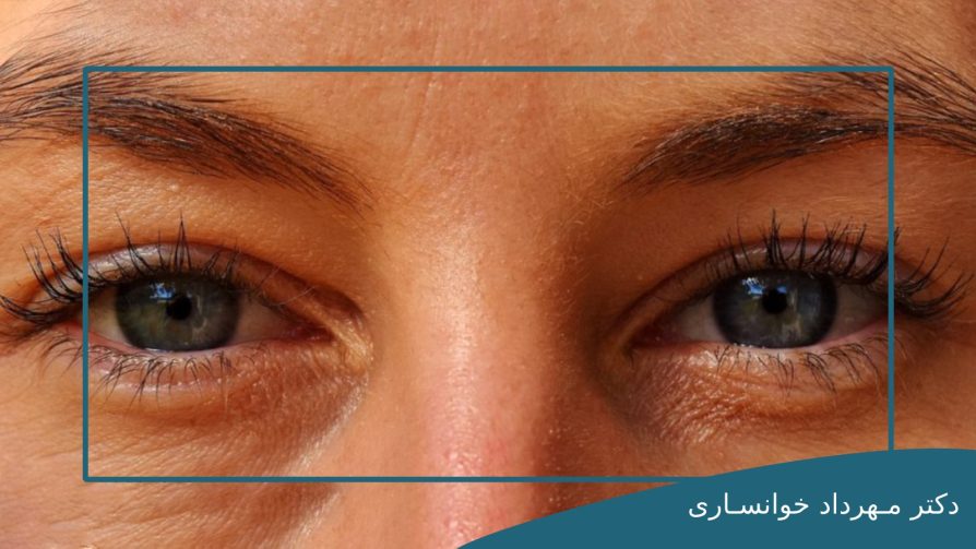 روش های درمان افتادگی پلک عصبی-dr-mkhansari