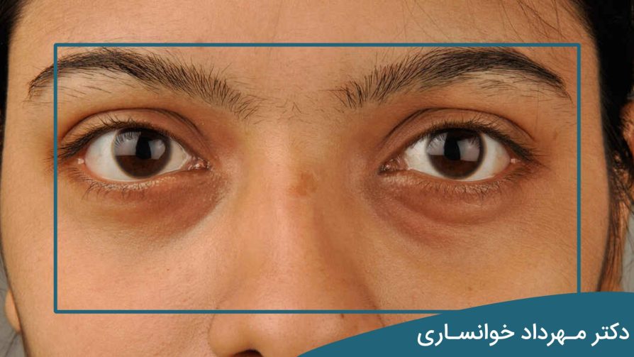 پف چشم بعد از خواب - dr-mkhansari.com