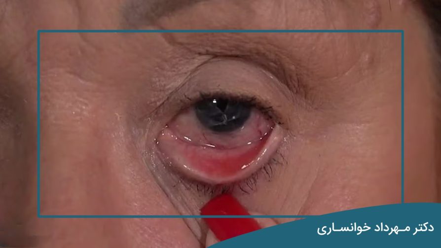 سرطان چشم - دکتر مهرداد خوانساری