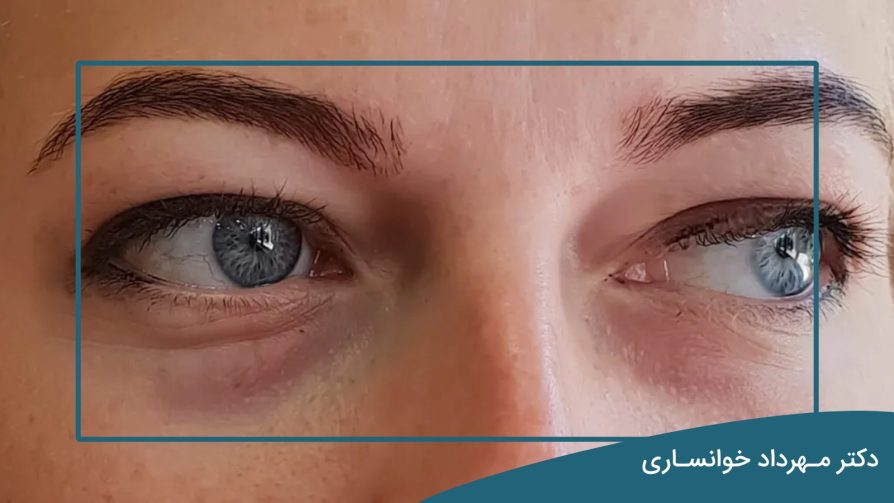 رابطه پف زیر چشم و کبد - دکتر مهرداد خوانساری