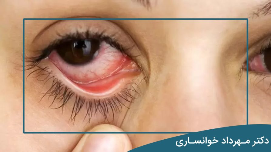 روماتیسم چشمی - dr-mkhansari
