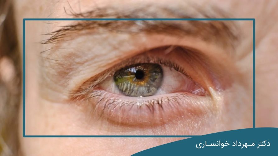 جراحی پلک افتاده-dr-mkhansari.com