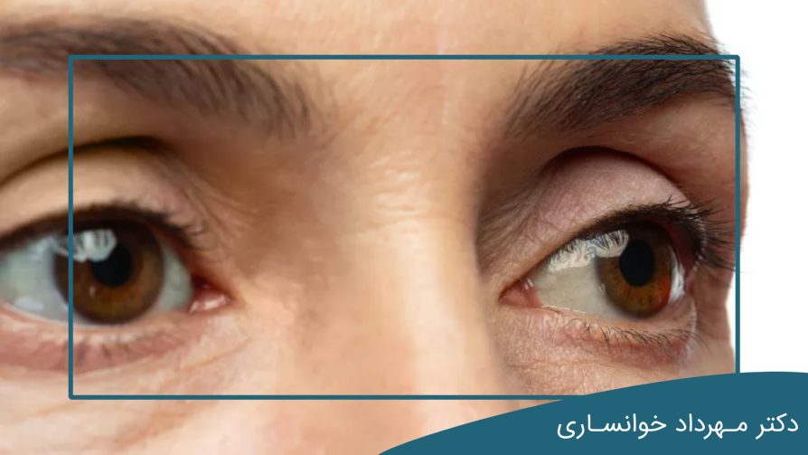 پف چشم تیروئید - dr-mkhansari