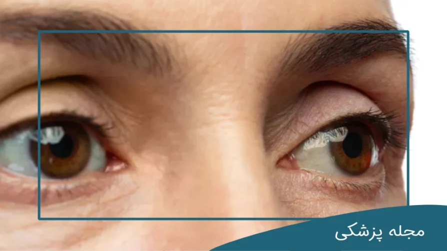 پف چشم تیروئید - dr-mkhansari